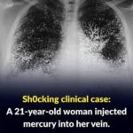Sh0cking clinical case: 21-year-old woman injected mercury into a vein.