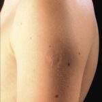 Smallpox vaccine scars: What they look like and why