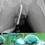 A young girl was hospitalized after attempting to use a male urination device