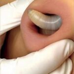 Why You Keep Getting Pimples Inside Your